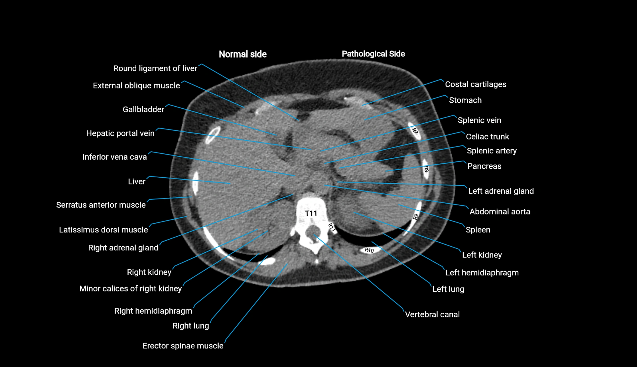 CT KUB axial cross sectional anatomy  radiology image -img-00201-00019.webp